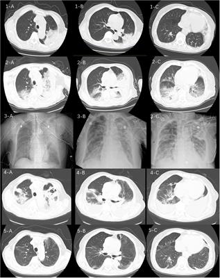 Severe community-acquired pneumonia caused by Chlamydia abortus in China: a case report